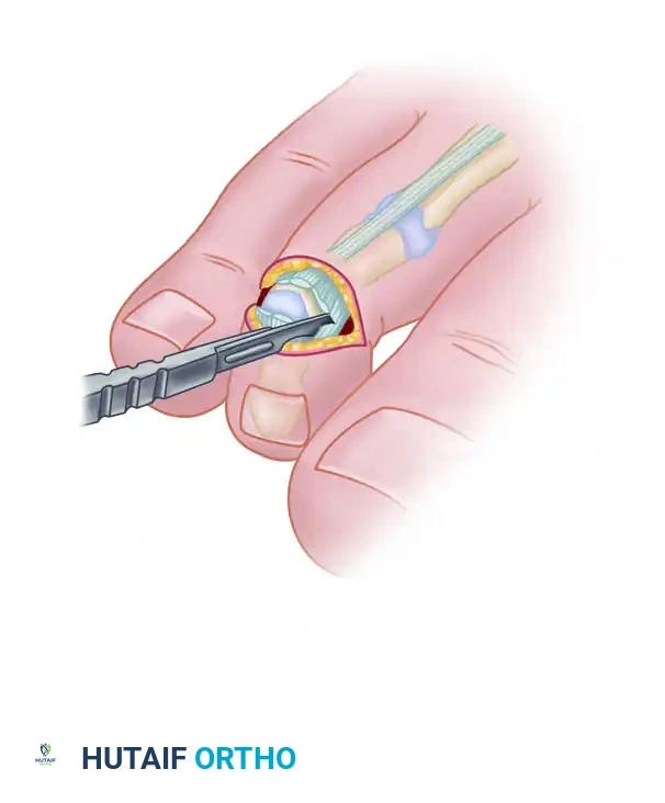 MALLET TOE Surgical Diagram