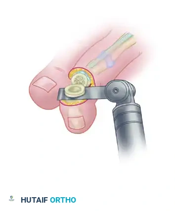 MALLET TOE Surgical Diagram
