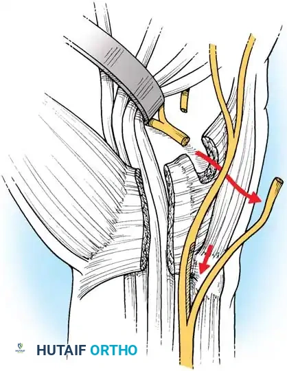 Boyes technique - Rerouting and Suture