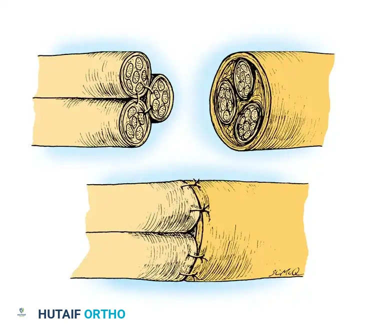 Bundle suture for segmental gap