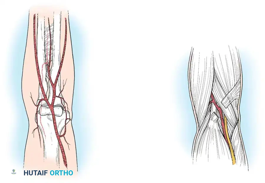 Management of Forearm Compartment Syndrome and Volkmann Ischemic Contracture