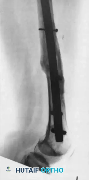 MASSIVE SLIDING GRAFT Surgical Diagram