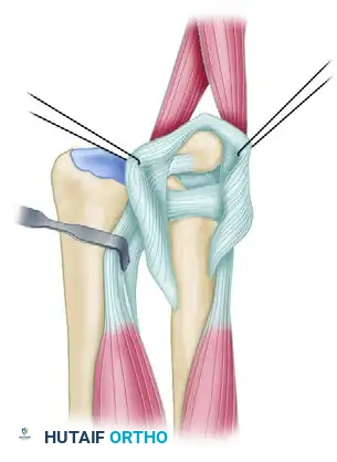 Matched and Wafer Distal Ulnar Resection: A Comprehensive Surgical Guide