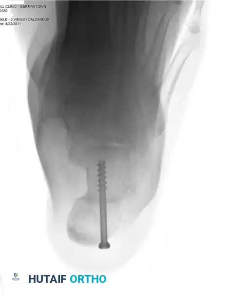 Preoperative Lateral Radiograph Demonstrating Arch Collapse