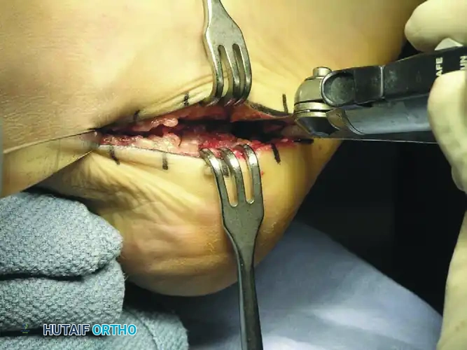 Posterior Tuberosity Displaced Medially