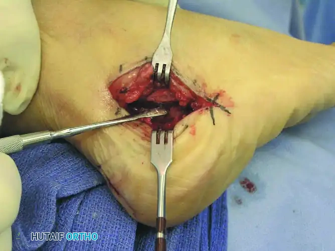 Lamina Spreader Inserted to Relax Medial Soft Tissues