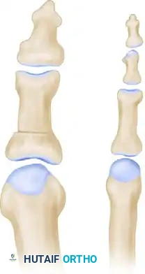 قياسات ما بعد الجراحة توضح مقدار التصحيح الزاوي الذي تم تحقيقه بعد عملية إيكن