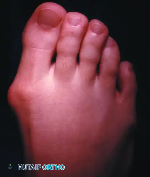 تشوه شديد في إصبع القدم الكبير مع تراكب الأصابع وهي حالة لا تناسب عملية إيكن وحدها