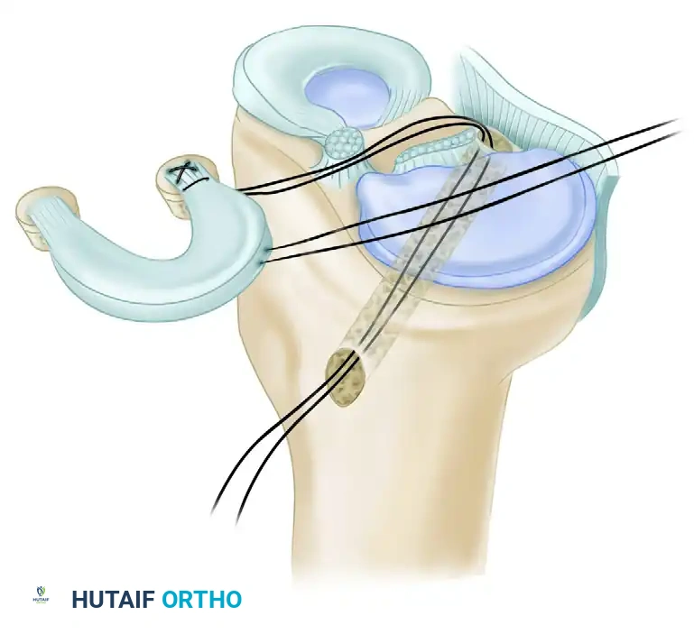 Prepared Graft with Bone Plugs