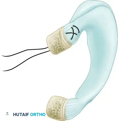 Meniscal Horn Detail