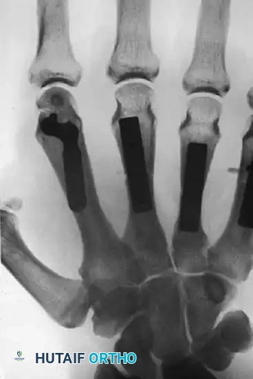METACARPAL HEAD FRACTURES Surgical Diagram