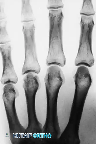 METACARPAL HEAD FRACTURES Surgical Diagram