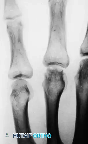 METACARPAL HEAD FRACTURES Surgical Diagram