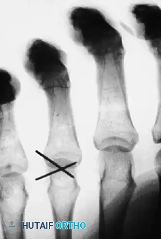METACARPAL HEAD FRACTURES Surgical Diagram