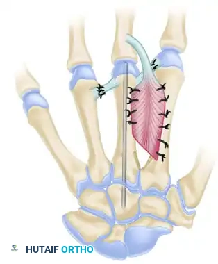 Metacarpal Lengthening: The Tajima Technique Masterclass