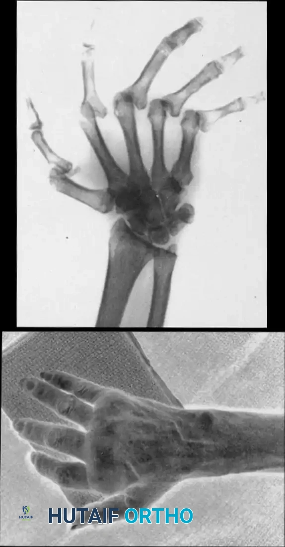 Metacarpophalangeal Arthroplasty: Comprehensive Surgical Techniques and Protocols