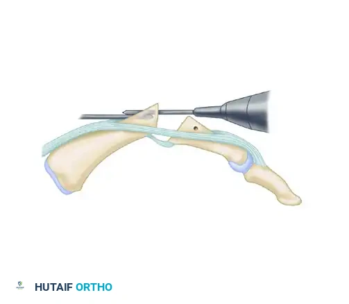 METACARPOPHALANGEAL JOINT ARTHRODESIS Surgical Diagram