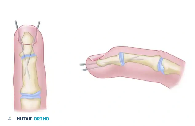 METACARPOPHALANGEAL JOINT ARTHRODESIS Surgical Diagram