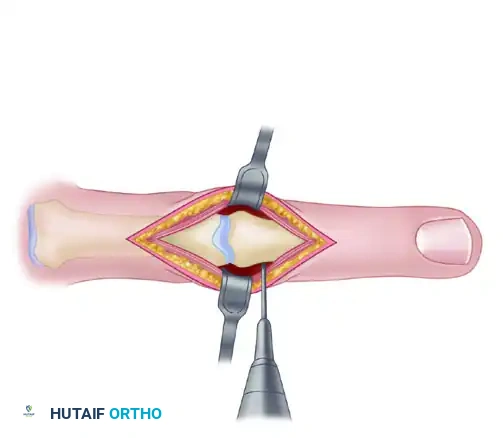 METACARPOPHALANGEAL JOINT ARTHRODESIS Surgical Diagram
