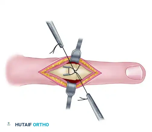 METACARPOPHALANGEAL JOINT ARTHRODESIS Surgical Diagram
