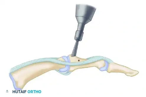 Metacarpophalangeal Joint Arthrodesis: Comprehensive Surgical Guide
