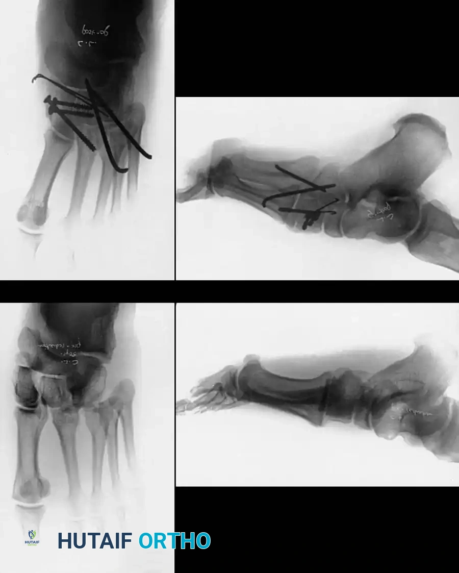 METATARSALS Surgical Diagram