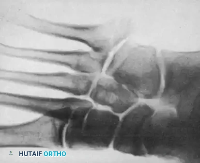 METATARSALS Surgical Diagram