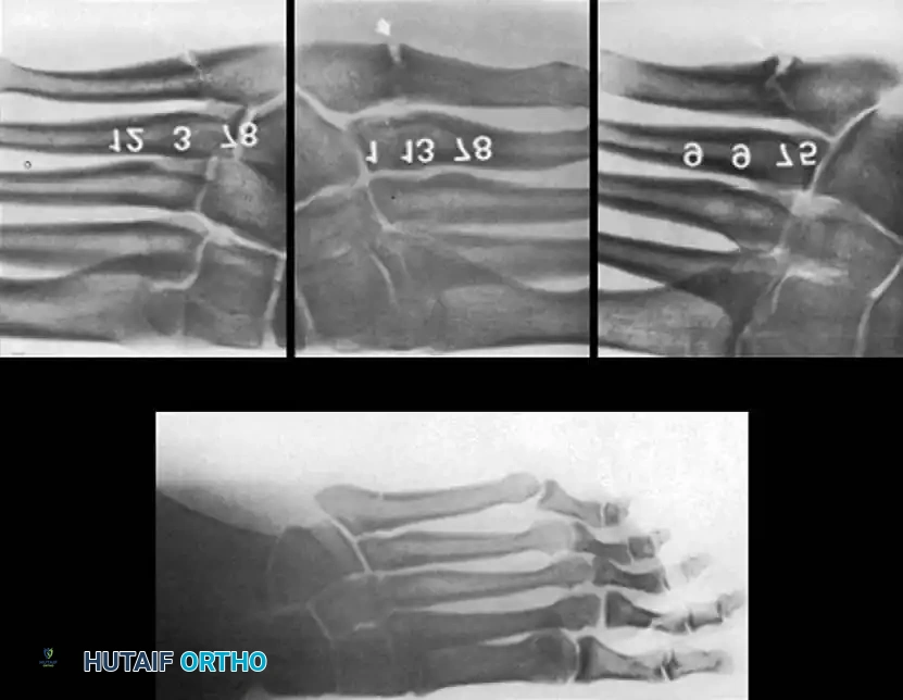 METATARSALS Surgical Diagram