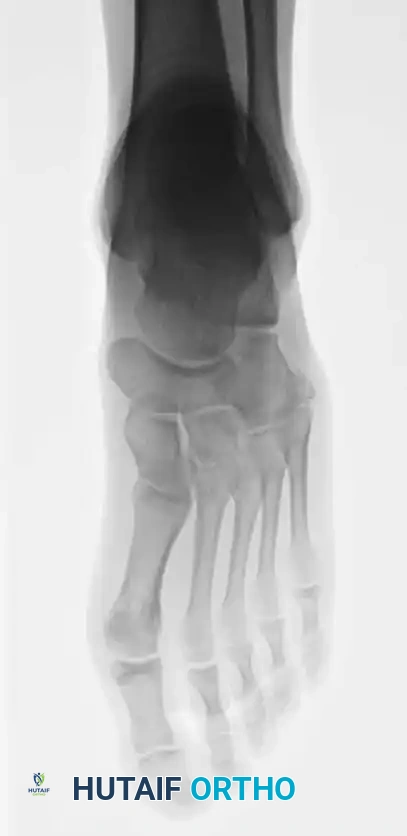 Fig. 86-44 A-C, Type IIIB (DeLee) fi fth metatarsal fracture.