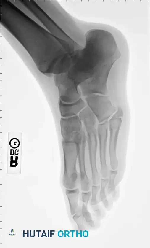 Fig. 86-44 A-C, Type IIIB (DeLee) fi fth metatarsal fracture.