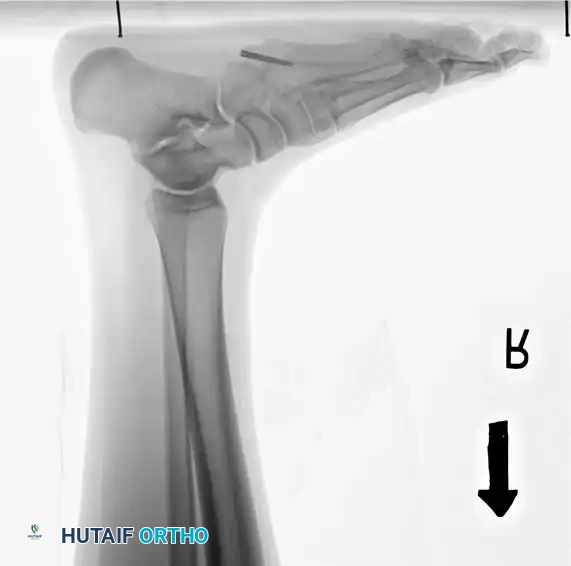 Fig. 86-44, cont’d D-F, After screw fi xation.