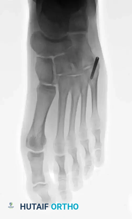 Fig. 86-44, cont’d D-F, After screw fi xation.