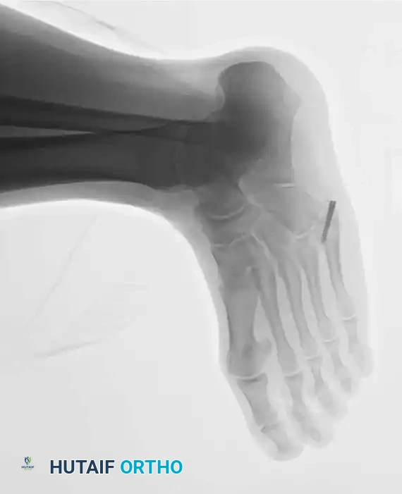 Fig. 86-44, cont’d D-F, After screw fi xation.