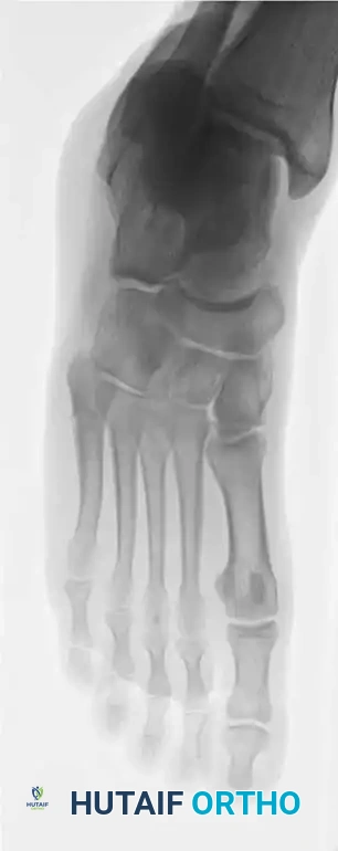 Fig. 86-45 A-C, Type IA (DeLee) fi fth metatarsal fracture in collegiate soccer player. D-F, After fi xation with variable pitch compression screw.