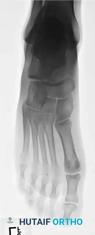Fig. 86-45 A-C, Type IA (DeLee) fi fth metatarsal fracture in collegiate soccer player. D-F, After fi xation with variable pitch compression screw.