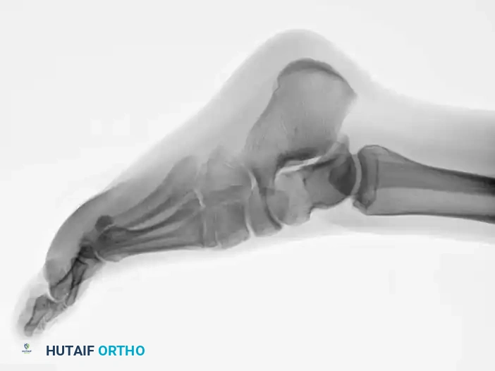 Fig. 86-45 A-C, Type IA (DeLee) fi fth metatarsal fracture in collegiate soccer player. D-F, After fi xation with variable pitch compression screw.