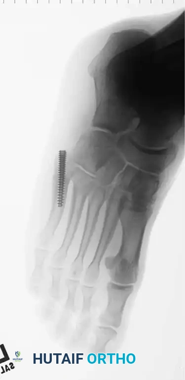 Fig. 86-45 A-C, Type IA (DeLee) fi fth metatarsal fracture in collegiate soccer player. D-F, After fi xation with variable pitch compression screw.