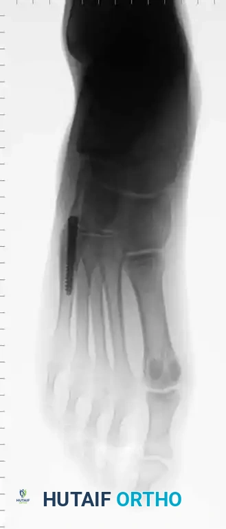 Fig. 86-45 A-C, Type IA (DeLee) fi fth metatarsal fracture in collegiate soccer player. D-F, After fi xation with variable pitch compression screw.