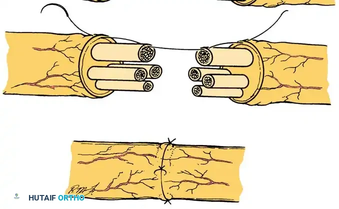 MICROSURGICAL TREATMENT OF NERVE INJURIES Surgical Diagram