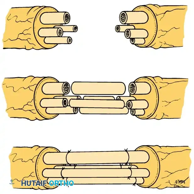 Nerve grafts placed between nerve ends A