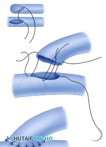 MICROVASCULAR END-TO-SIDE ANASTOMOSIS Surgical Diagram