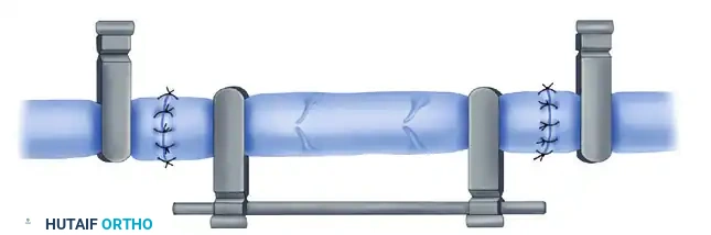 MICROVASCULAR END-TO-SIDE ANASTOMOSIS Surgical Diagram