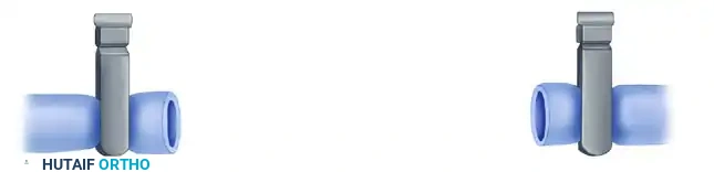 MICROVASCULAR END-TO-SIDE ANASTOMOSIS Surgical Diagram