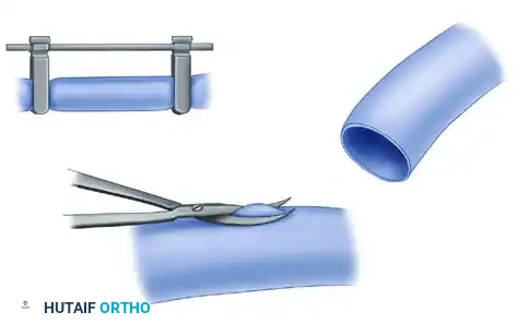 MICROVASCULAR END-TO-SIDE ANASTOMOSIS Surgical Diagram