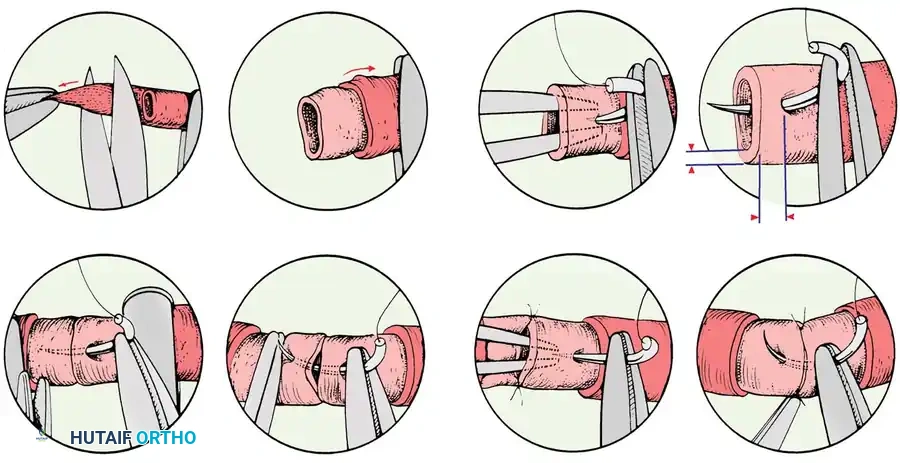 Masterclass in Microvascular Techniques: Anastomosis, Vein Grafting, and Neurorrhaphy