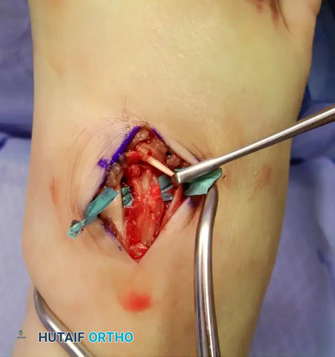 رسم توضيحي يوضح مواقع الشقوق الجراحية في منتصف القدم