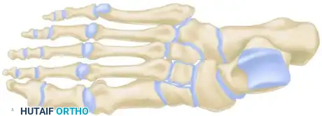 MIDFOOT FRACTURES AND DISLOCATIONS Surgical Diagram