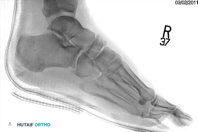 MIDFOOT FRACTURES AND DISLOCATIONS Surgical Diagram