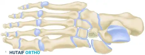 MIDFOOT FRACTURES AND DISLOCATIONS Surgical Diagram