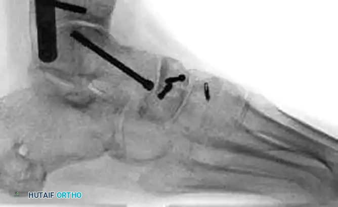 MIDFOOT FRACTURES AND DISLOCATIONS Surgical Diagram